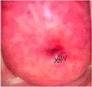 Colposcopy for abnormal pap smears