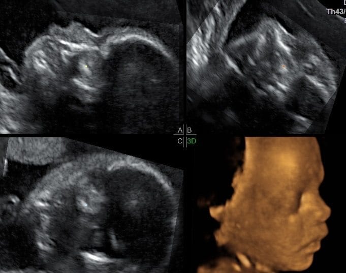4d ultrasound scans by brisbane obstetrician