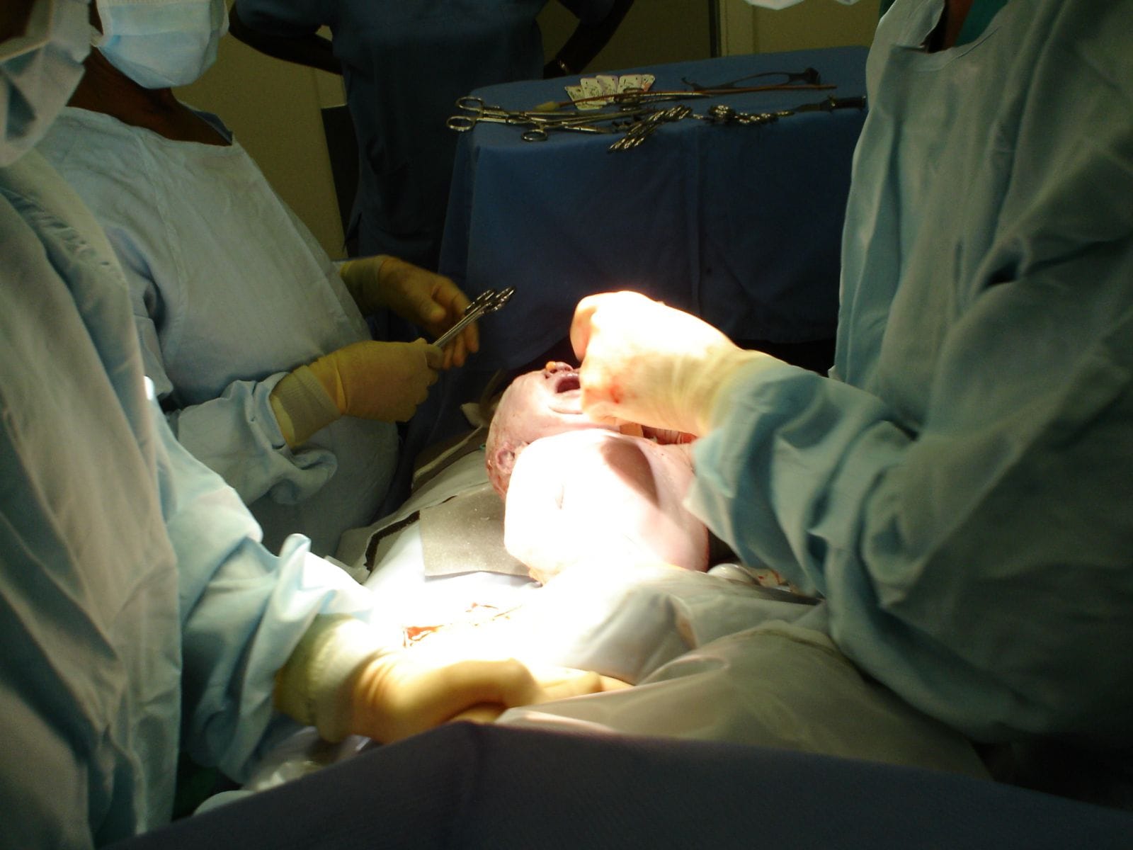 Caesarean